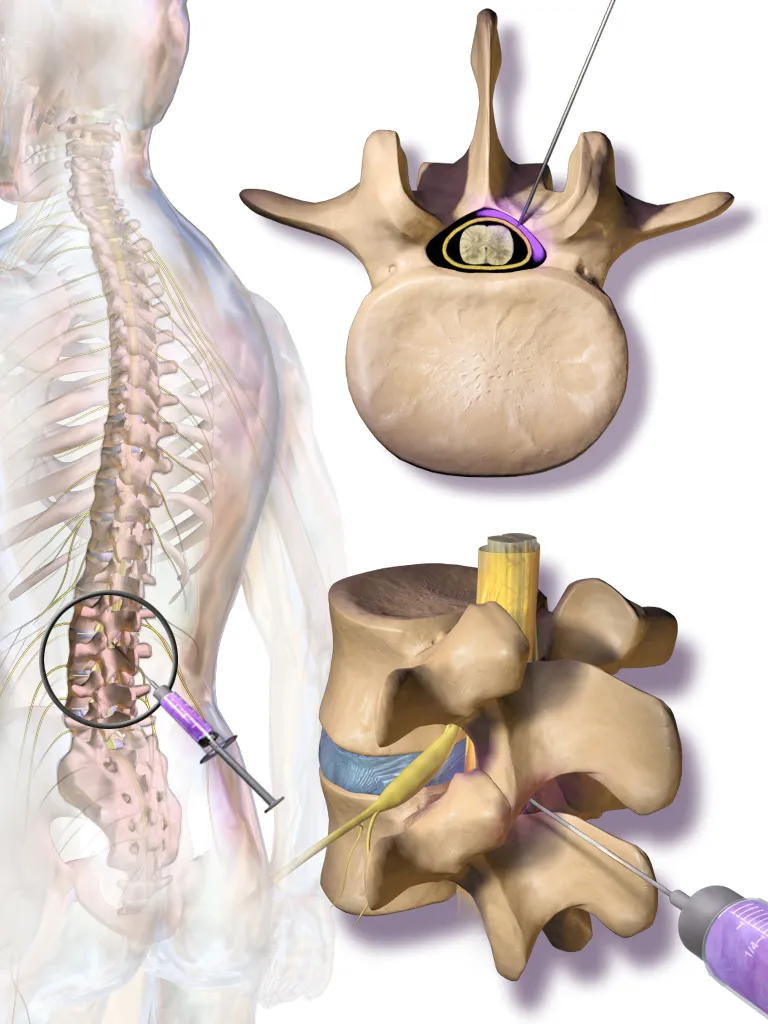 Epidural enjeksiyon çizimi