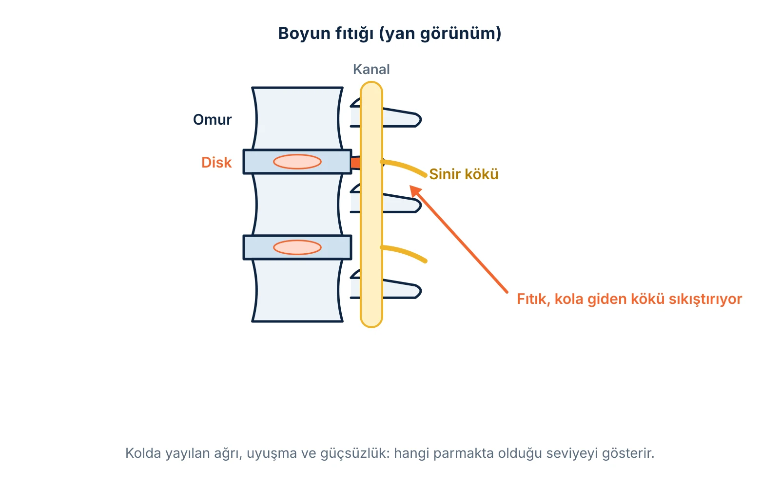 Boyun fıtığı: yan görünümde disk parçasının kola giden sinir köküne baskısı