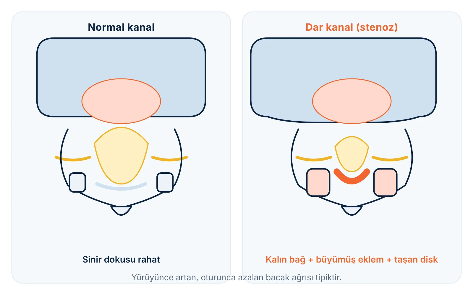 Dar kanal: normal kanal ile kemik ve bağ kalınlaşmasıyla daralmış kanalın karşılaştırması