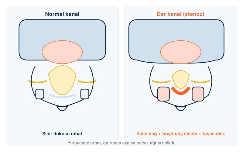 Dar kanal: normal kanal ile kemik ve bağ kalınlaşmasıyla daralmış kanalın karşılaştırması