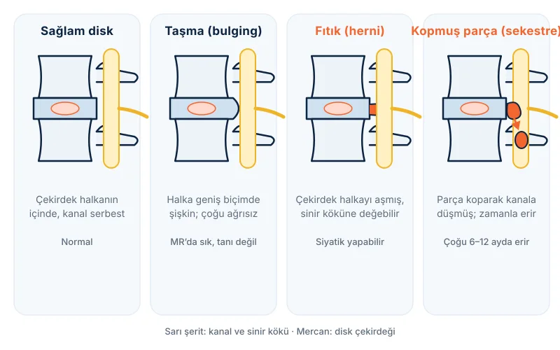 Disk sorunlarının dört evresi: sağlam disk, taşma (bulging), fıtık (herni) ve kopmuş parça (sekestre)