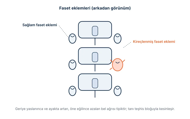 Faset eklemleri: omurların arkasındaki küçük eklemler ve kireçlenmesi