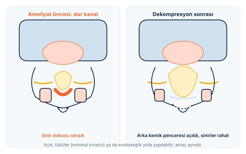 Dekompresyon (laminektomi): kanalı daraltan kemik ve bağın alınarak sinirlerin rahatlatılması