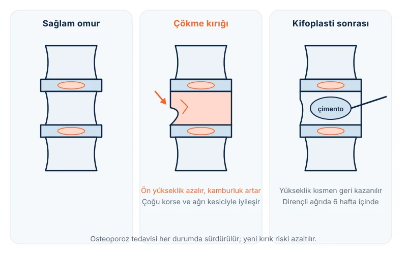 Omur çökme kırığı ve kifoplasti: çöken omurun balonla açılıp kemik çimentosuyla doldurulması