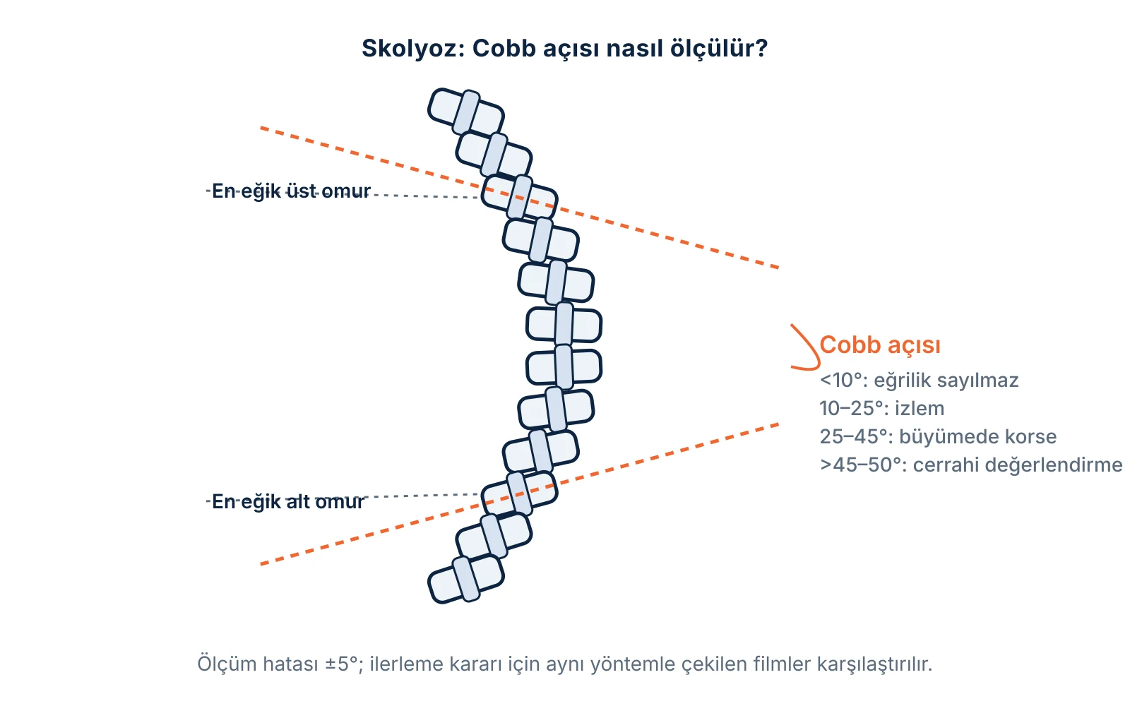 Skolyoz ve Cobb açısı: eğriliğin en eğik üst ve alt omurlarından çizilen çizgiler arasındaki açı