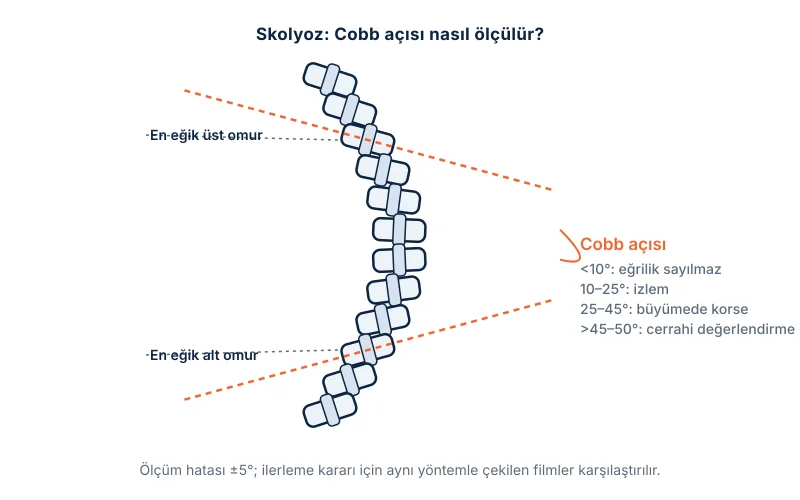 Skolyoz ve Cobb açısı: eğriliğin en eğik üst ve alt omurlarından çizilen çizgiler arasındaki açı